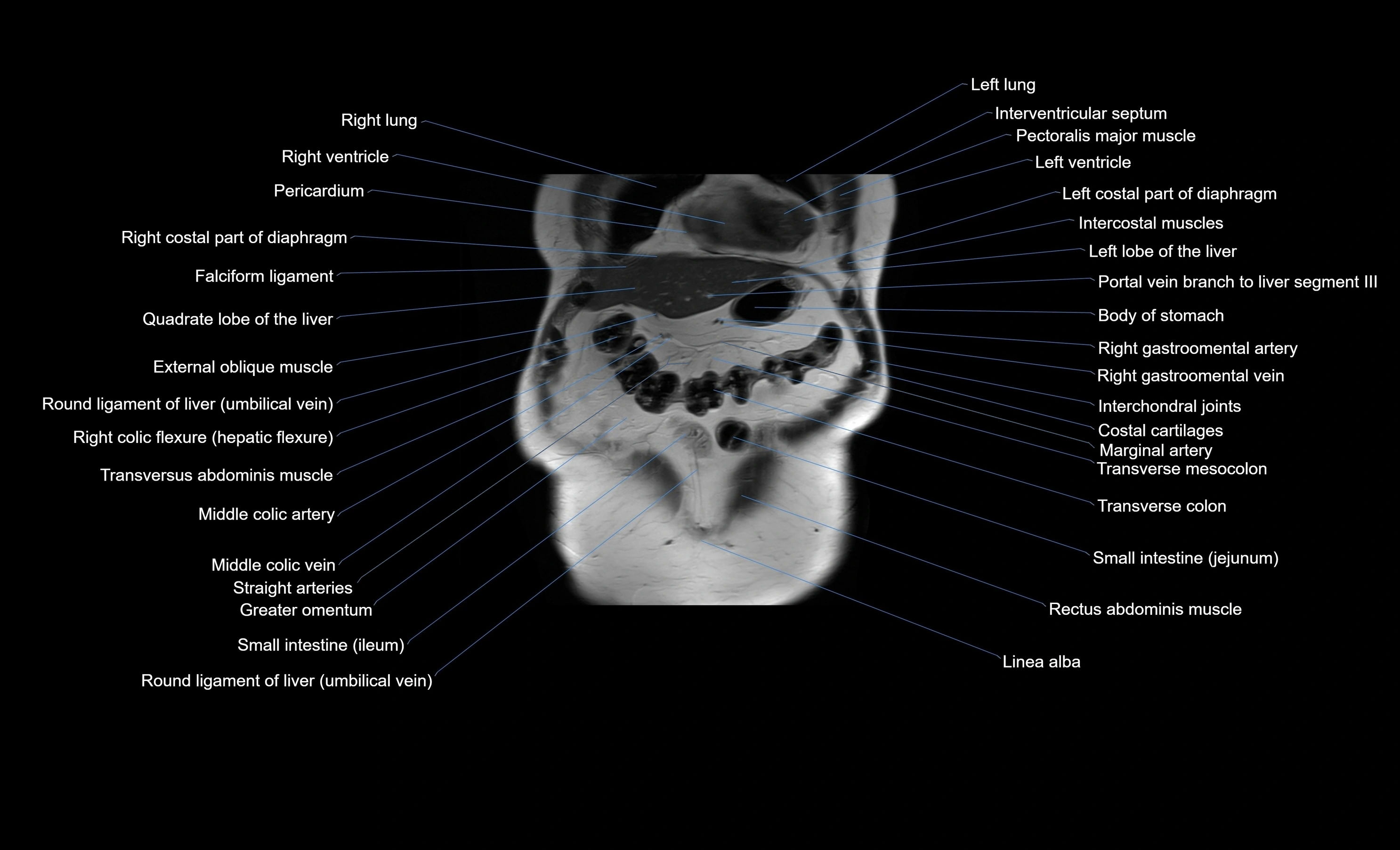 MRI Abdomen coronal labelled cross sectional anatomy radiology  image-img-00001-00012.webp